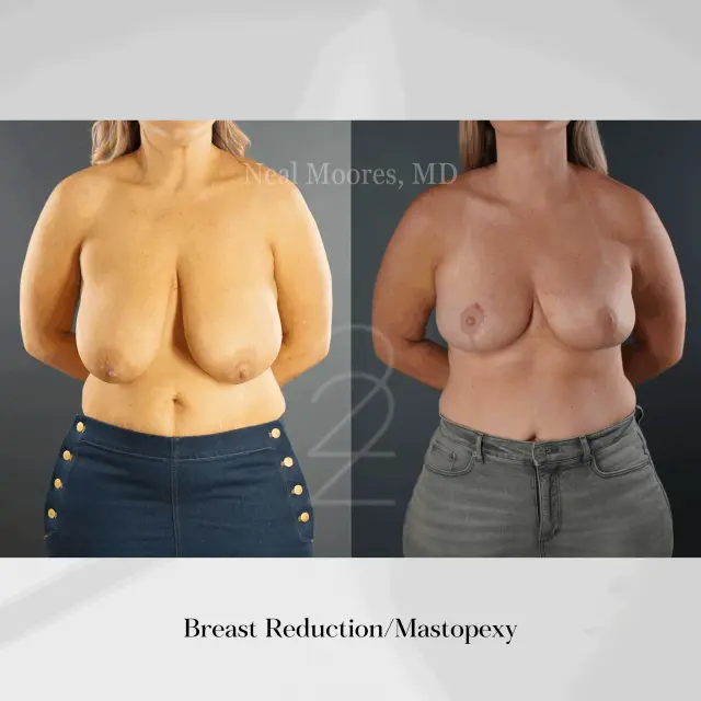 Breast Reduction result at 22 Plastic Surgery & Spa MD in Cottonwood Heights, UT