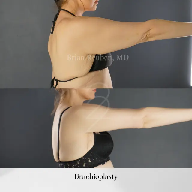 Arm Lift result at 22 Plastic Surgery & Spa MD in Cottonwood Heights, UT