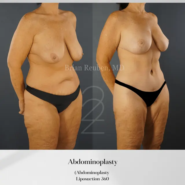 Tummy Tuck result at 22 Plastic Surgery & Spa MD in Cottonwood Heights, UT