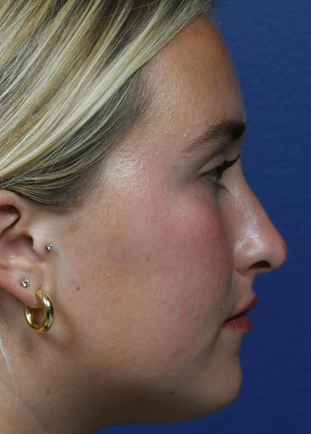 Functional Rhinoplasty before at Seattle Face and Skin in Seattle, WA
