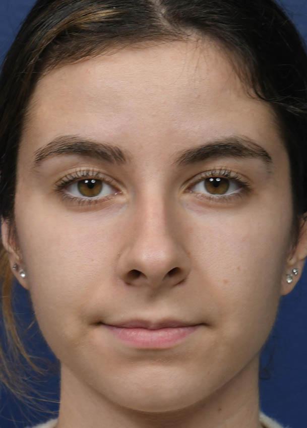 Seattle Face and Skin rhinoplasty result — Seattle, WA