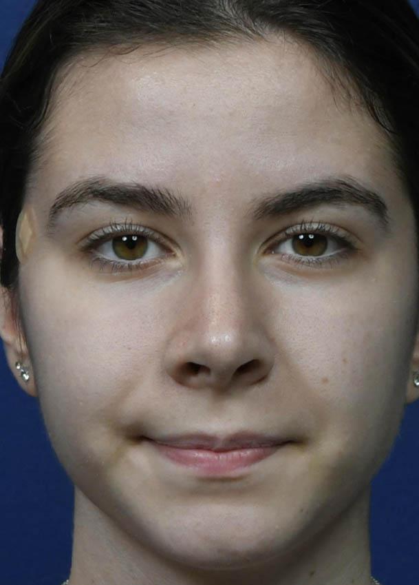 Rhinoplasty result at Seattle Face and Skin in Seattle, WA