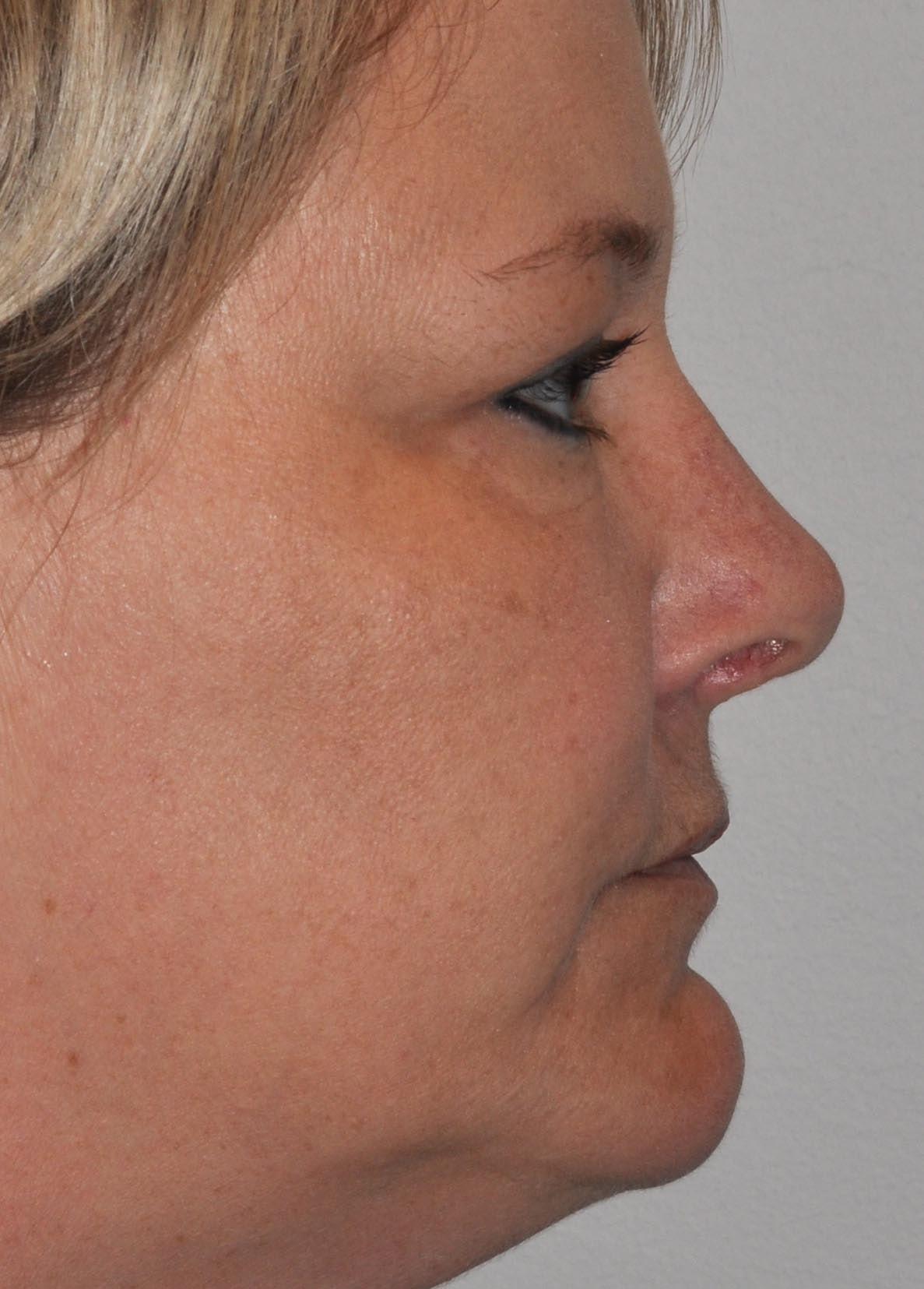 Seattle Face and Skin rhinoplasty after — Seattle, WA