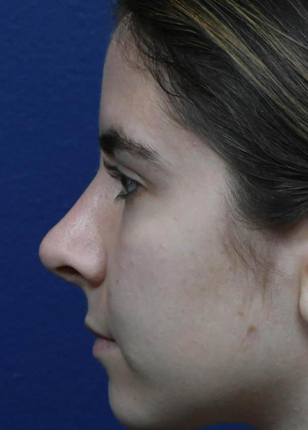 Rhinoplasty result at Seattle Face and Skin in Seattle, WA