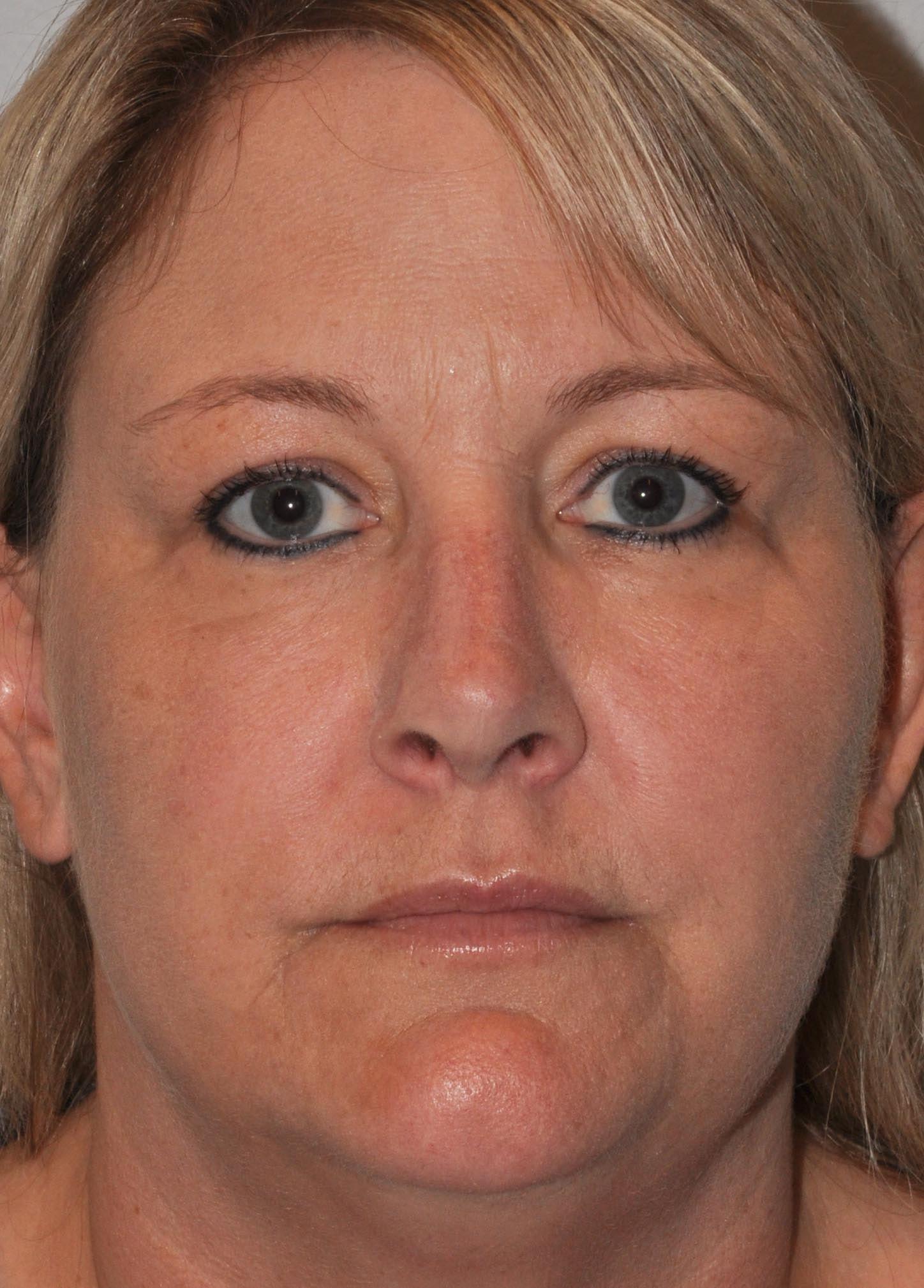 Seattle Face and Skin rhinoplasty after — Seattle, WA
