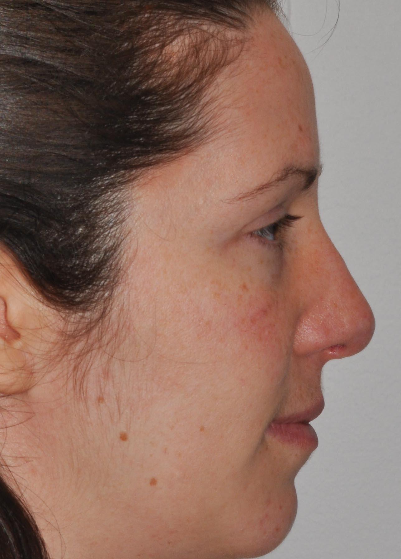 Seattle Face and Skin rhinoplasty after — Seattle, WA