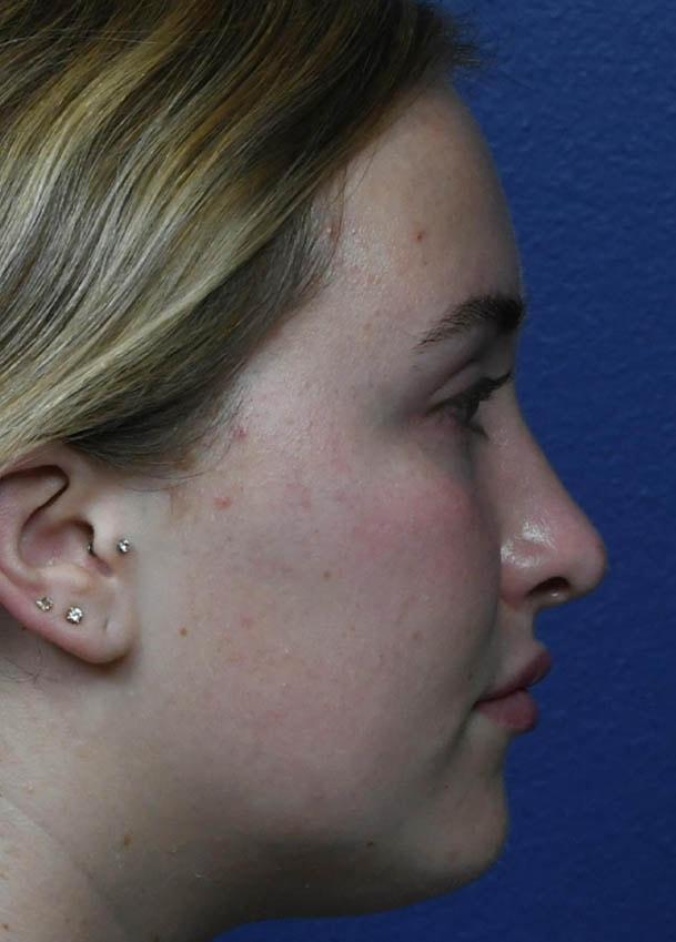 Seattle Face and Skin rhinoplasty after — Seattle, WA