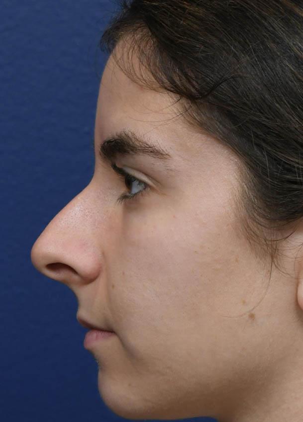 Seattle Face and Skin rhinoplasty result — Seattle, WA