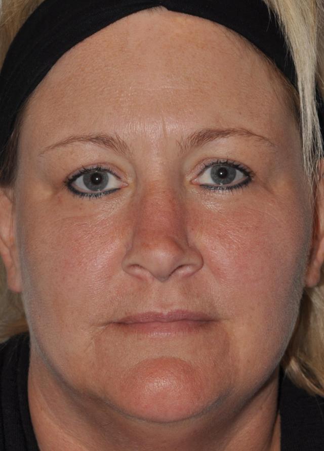 Rhinoplasty before at Seattle Face and Skin in Seattle, WA