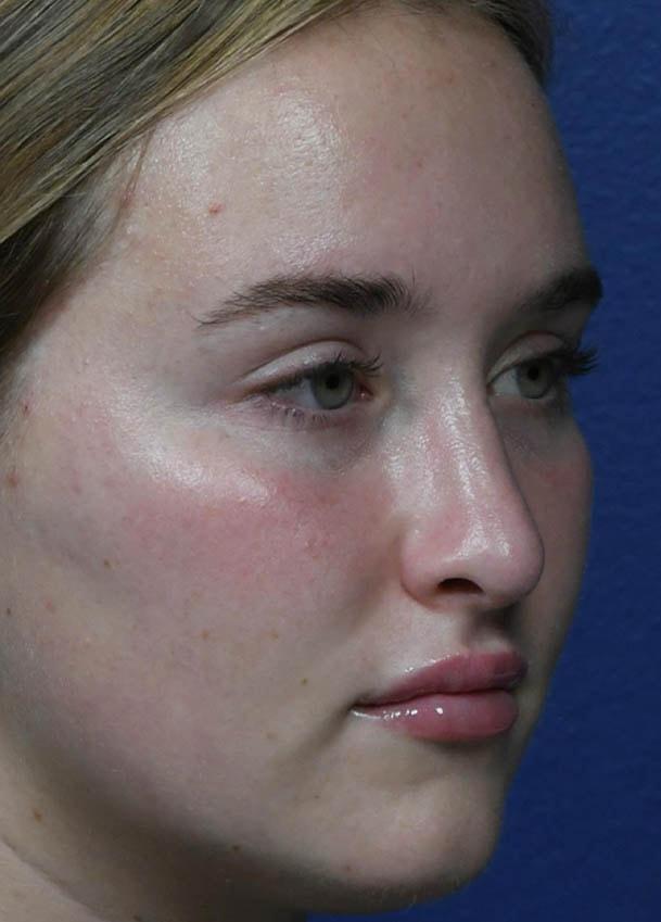 Seattle Face and Skin rhinoplasty after — Seattle, WA
