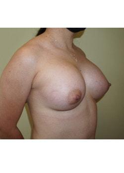 Breast Augmentation after at Woodbury Plastic Surgery, David Thao, MD in Woodbury, MN
