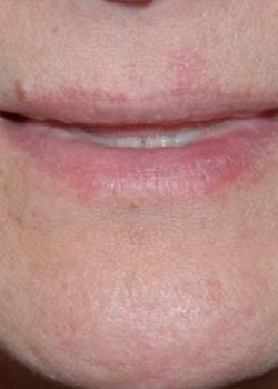 Laser Skin Resurfacing after at Woodbury Plastic Surgery, David Thao, MD in Woodbury, MN
