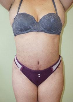 Woodbury Plastic Surgery, David Thao, MD tummy tuck after — Woodbury, MN