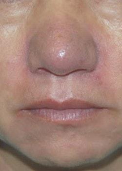 Laser Skin Resurfacing after at Woodbury Plastic Surgery, David Thao, MD in Woodbury, MN