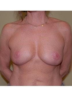 Breast Reduction after at Woodbury Plastic Surgery, David Thao, MD in Woodbury, MN