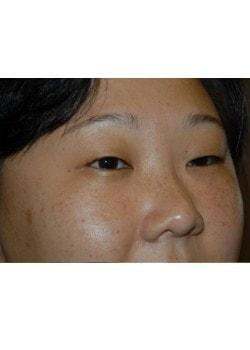 Laser Skin Resurfacing before at Woodbury Plastic Surgery, David Thao, MD in Woodbury, MN