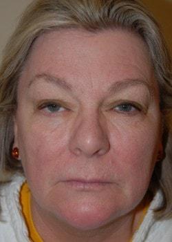 Blepharoplasty before at Woodbury Plastic Surgery, David Thao, MD in Woodbury, MN