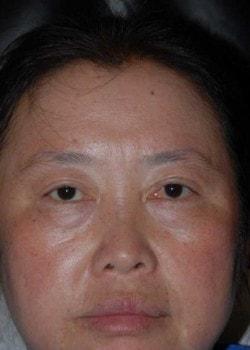 Blepharoplasty after at Woodbury Plastic Surgery, David Thao, MD in Woodbury, MN