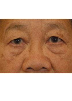 Blepharoplasty before at Woodbury Plastic Surgery, David Thao, MD in Woodbury, MN