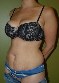 Mini Tummy Tuck before at Woodbury Plastic Surgery, David Thao, MD in Woodbury, MN