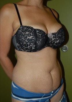 Mini Tummy Tuck before at Woodbury Plastic Surgery, David Thao, MD in Woodbury, MN
