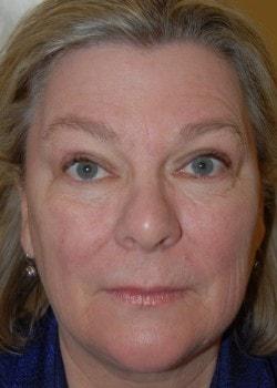 Blepharoplasty after at Woodbury Plastic Surgery, David Thao, MD in Woodbury, MN
