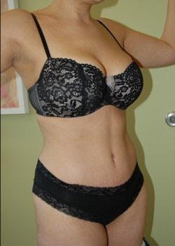 Woodbury Plastic Surgery, David Thao, MD tummy tuck after — Woodbury, MN