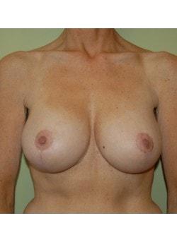 Breast Lift after at Woodbury Plastic Surgery, David Thao, MD in Woodbury, MN