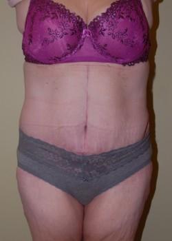 Mini Tummy Tuck after at Woodbury Plastic Surgery, David Thao, MD in Woodbury, MN