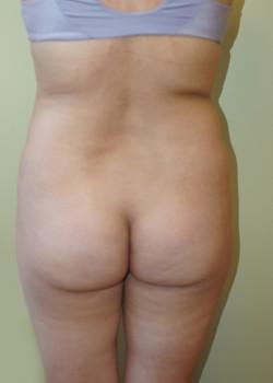 Liquid BBL before at Woodbury Plastic Surgery, David Thao, MD in Woodbury, MN