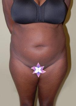 Mini Tummy Tuck before at Woodbury Plastic Surgery, David Thao, MD in Woodbury, MN