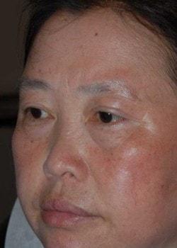 Blepharoplasty after at Woodbury Plastic Surgery, David Thao, MD in Woodbury, MN