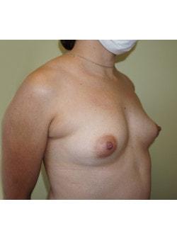 Breast Augmentation before at Woodbury Plastic Surgery, David Thao, MD in Woodbury, MN