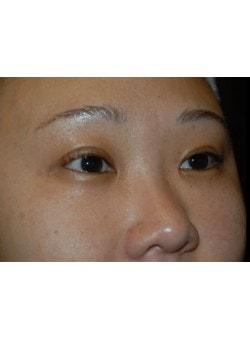 Laser Skin Resurfacing after at Woodbury Plastic Surgery, David Thao, MD in Woodbury, MN