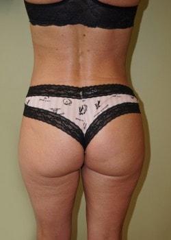 Brazilian Butt Lift after at Woodbury Plastic Surgery, David Thao, MD in Woodbury, MN