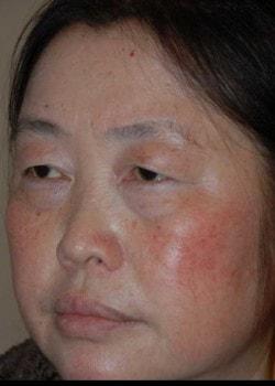 Blepharoplasty before at Woodbury Plastic Surgery, David Thao, MD in Woodbury, MN