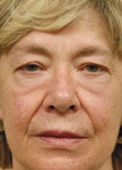 Blepharoplasty before at Woodbury Plastic Surgery, David Thao, MD in Woodbury, MN