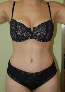 Woodbury Plastic Surgery, David Thao, MD tummy tuck after — Woodbury, MN