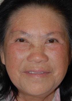 Blepharoplasty after at Woodbury Plastic Surgery, David Thao, MD in Woodbury, MN