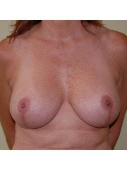 Breast Lift after at Woodbury Plastic Surgery, David Thao, MD in Woodbury, MN