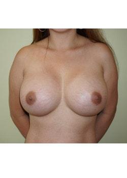 Breast Augmentation after at Woodbury Plastic Surgery, David Thao, MD in Woodbury, MN