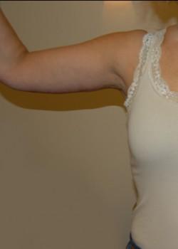 Woodbury Plastic Surgery, David Thao, MD after — Woodbury, MN