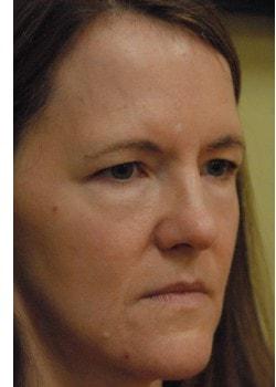 Blepharoplasty before at Woodbury Plastic Surgery, David Thao, MD in Woodbury, MN