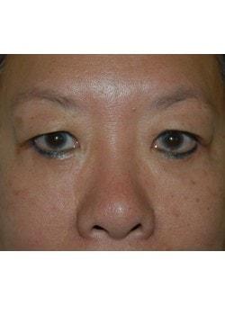 Blepharoplasty after at Woodbury Plastic Surgery, David Thao, MD in Woodbury, MN