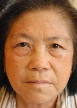 Blepharoplasty before at Woodbury Plastic Surgery, David Thao, MD in Woodbury, MN