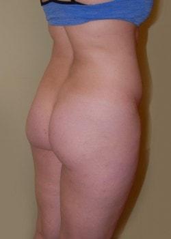 Brazilian Butt Lift before at Woodbury Plastic Surgery, David Thao, MD in Woodbury, MN