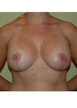 Breast Lift after at Woodbury Plastic Surgery, David Thao, MD in Woodbury, MN