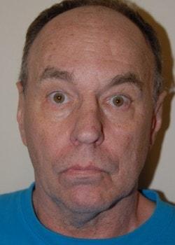 Mini Facelift before at Woodbury Plastic Surgery, David Thao, MD in Woodbury, MN