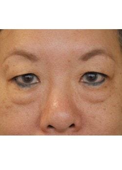Blepharoplasty before at Woodbury Plastic Surgery, David Thao, MD in Woodbury, MN
