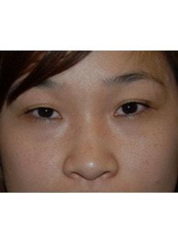 Laser Skin Resurfacing before at Woodbury Plastic Surgery, David Thao, MD in Woodbury, MN